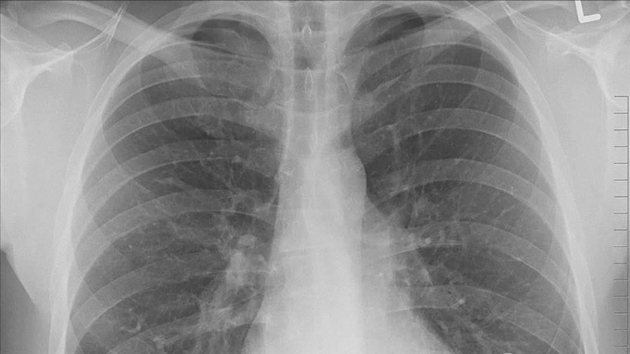 Koah Hastaları Akciğer Kanseri Açısından da Risk Altında