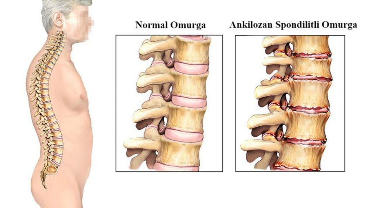 As hastalığının tedavisi henüz yok