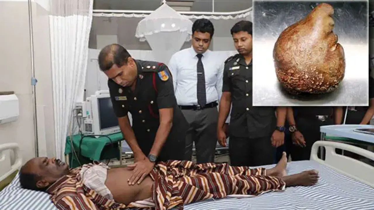 Sri Lanka'da bir hastadan 3,1 kilogram ağırlığında mesane taşı çıkarıldı