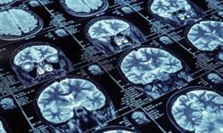 İngiltere'de Alzheimer'ın Erken Teşhisi İçin Kan Testi Deneyleri Yapılacak