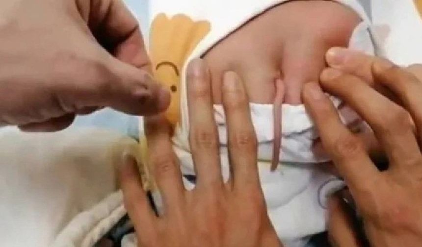 Hindistan'da 3 Aylık Bebeğin "kuyruğu" Ameliyatla Çıkarıldı