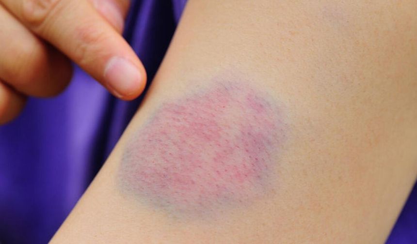 Uzmanlar Cildin Kolayca Morarmasının Sebebini Açıkladı