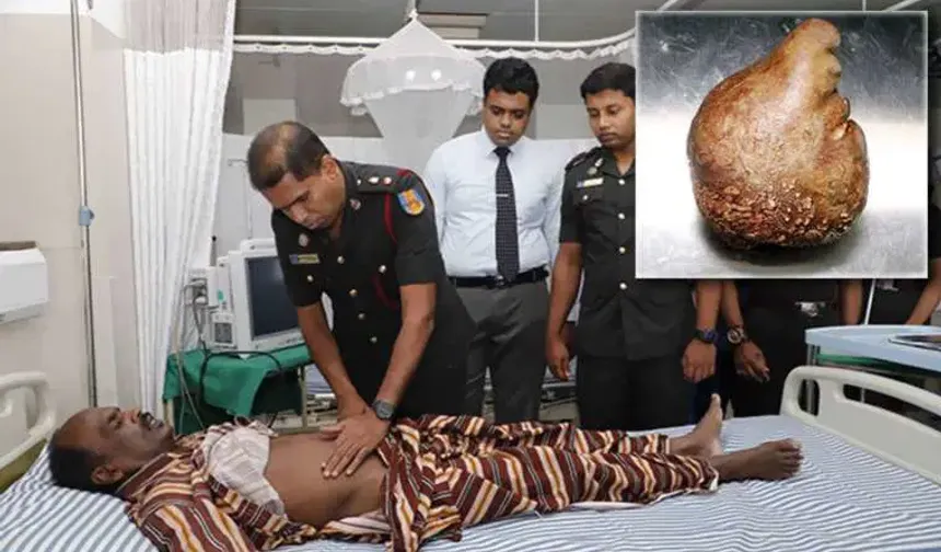 Sri Lanka'da bir hastadan 3,1 kilogram ağırlığında mesane taşı çıkarıldı
